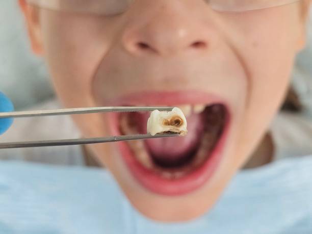 Best Chipped Tooth Repair Near Me  in Somerset, TX
